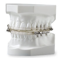 Herbst Dental Appliance