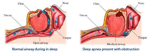 Sleep Apnea